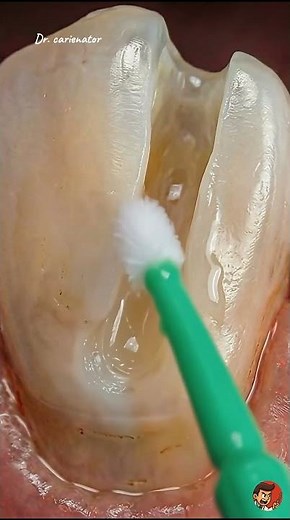 Fixing a Broken Tooth: Composite Resin Restoration | Realistic Dental ASMR