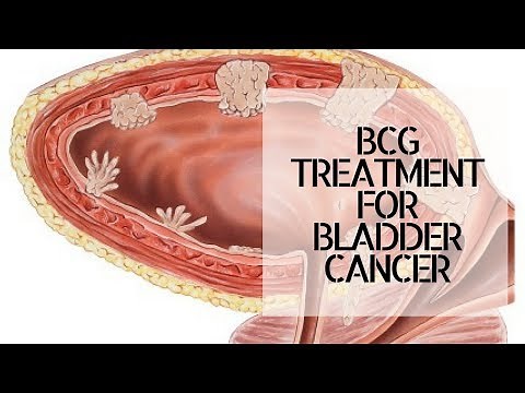 BCG TREATMENT FOR BLADDER CANCER