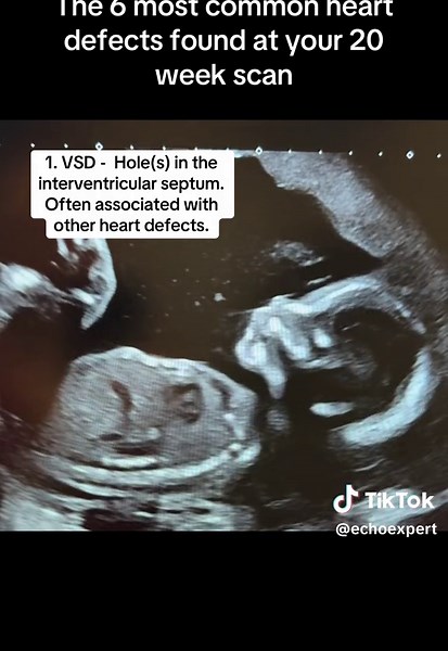 6 Common Fetal Heart Defects Detected at 20 Week Scan