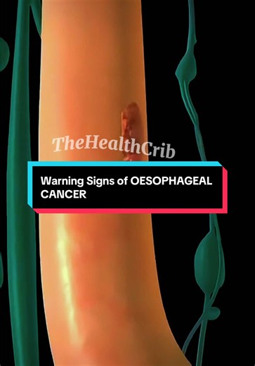 Recognizing Warning Signs of Esophageal Cancer