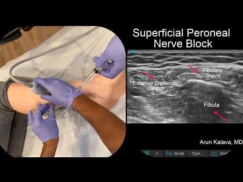 Superficial Peroneal Nerve Block- Ultrasound Guided