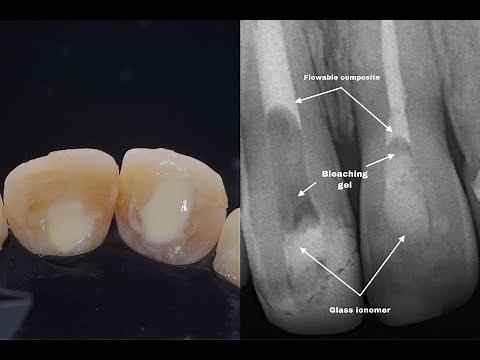 Internal Bleaching Case Presentation