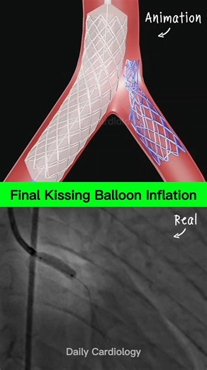 Coronary Angioplasty with final kissing balloon inflation tachnique #angioplasty #cardiology