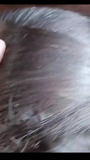 #headlice #lice #headlicetreatment #licetreatment #headliceremoval | Lice Remove Reels