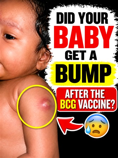 That BCG bump is scary at first, but here’s the truth! 🩺👇 Seeing a bump, pimple, or even a tiny bit of pus at your baby’s vaccination site can definitely trigger some serious new-mom anxiety! But in most cases, it is a completely normal reaction to the BCG vaccine. ✨ What’s happening? The BCG vaccine is working hard to build immunity. The bump usually appears 2 to 6 weeks after the injection, might grow slightly, form a small ulcer or blister, and then heal on its own, leaving a tiny signature