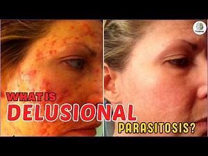 What is Delusional Parasitosis? Symptoms and Treatments