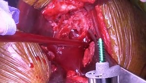 AEQUALIS PERFORM REVERSED Glenoid for augmentation of superiorly worn glenoid featuring Dr. Gregory Nicholson