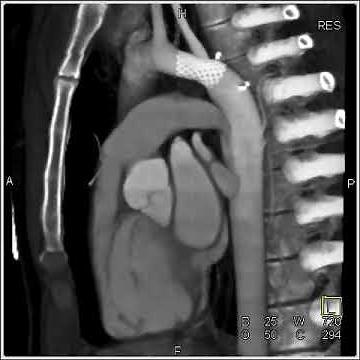 Cardiac: Repair of coarctation of aorta with stent (2 of 3)