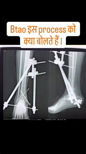 Verma X-Ray and Orthocare Center on Instagram: "बताओ क्या बोलते है इस प्रोसेस को। Follow for more. . . #viral #medical #explorepage #operation #medstudentlife"
