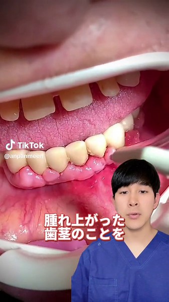 歯肉増殖症の原因と治療法
