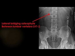 case 604 Lateral bridging osteophyte