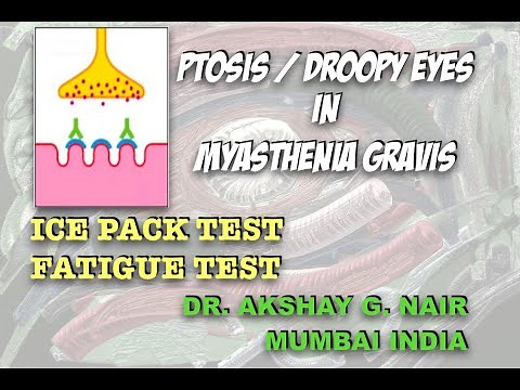 Ice Pack test and Fatigue test - Ocular Myasthenia - Ptosis/Droopy Eyes (Dr. Akshay G. Nair, Mumbai)