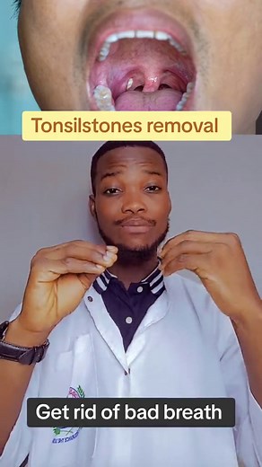 Tonsilstones removal Here are five ways to dislodge tonsil stones: 1. Gargling with Salt Water: Regularly gargling with warm salt water can help loosen tonsil stones and reduce discomfort. The saltwater can also help reduce inflammation and kill bacteria. 2. Manual Removal: Using a cotton swab or a clean finger, you can gently press on the tonsil tissue to dislodge the stones. This should be done carefully to avoid causing injury or infection. 3. Oral Irrigator: A water flosser or oral irrigator