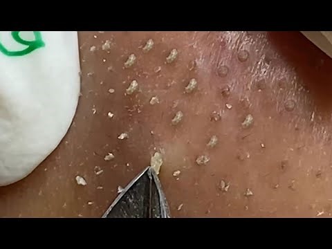 Loan Nguyen Acne Treatment (#152)