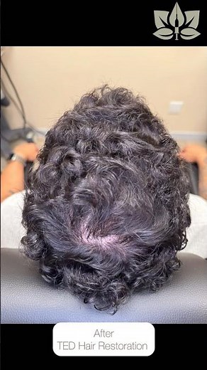 Xavier Blanco TED Hair Restoration | Before & After Results