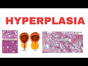 Cellular Adaptations: HYPERPLASIA- Types, Mechanism & Consequences