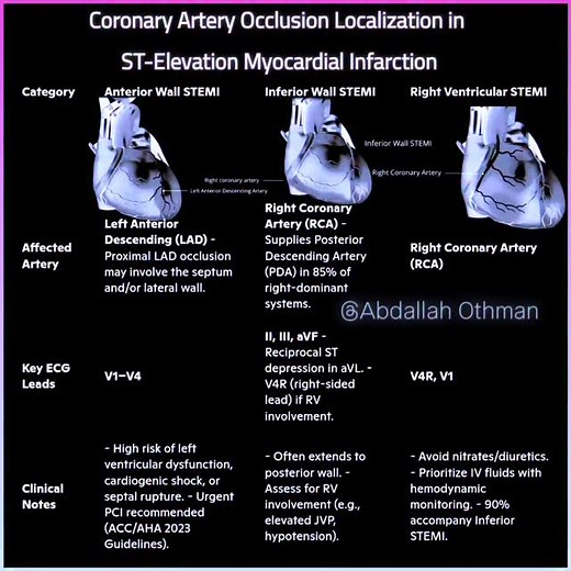 Figure 1: Diagnostic and management guide for Anterior, Inferior, and Right Ventricular ST-Elevation Myocardial Infarction (STEMI), correlating infarct location, culprit artery, key ECG leads, and critical clinical considerations. #STEMI #Cardiology #ECG #EmergencyMedicine #MedEd | Abdallah Othman