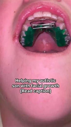 Autism & ADHD BIOmedical therapy USA on Instagram: "Facial Orthotropics: The Key to Balanced Facial Growth ⬇️ As of today, facial orthotropics is the only method capable of redirecting facial growth from a vertical to a horizontal direction. This technique corrects imbalances that prevent facial bones from developing harmoniously, ultimately shaping a more aesthetically balanced appearance. A child should be the best version of their parents—a perfect combination of natural genetics and harmony.