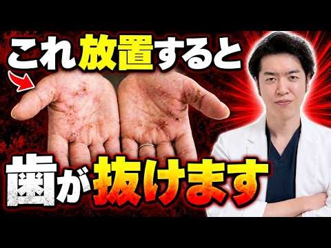 手足のブツブツは「全身の病気の始まり」？歯科医が教える掌蹠膿疱症の真実と根本治療について