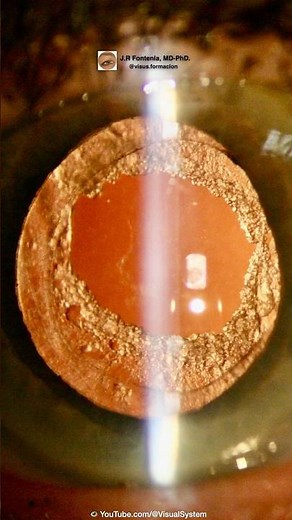 YAG Laser Capsulotomy. #ophthalmology #cataracttreatment #cataractsurgeon #cataractdisease