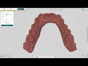 Faster Passive Retainers Creation with Titan Dental Design