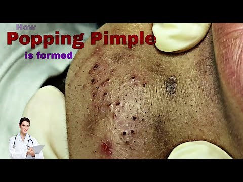 Pimples Popping is Satisfying But How do they form