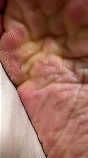 Wrinkled Soles and Arches