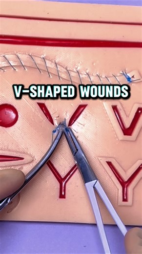 Vetventures on Instagram: "Suturing V-Shaped Wounds 😷 ‼️Holiday Sale‼️🎄🎅 You will get a FREE Suture Removal Kit with every Suture Kit from @thesuturebuddy! Link in bio ⬆️ (Great gift idea for the holiday season! 🎁) #medicalinstagram #medicalstudent #vetstudent #nursingstudent #suturing"