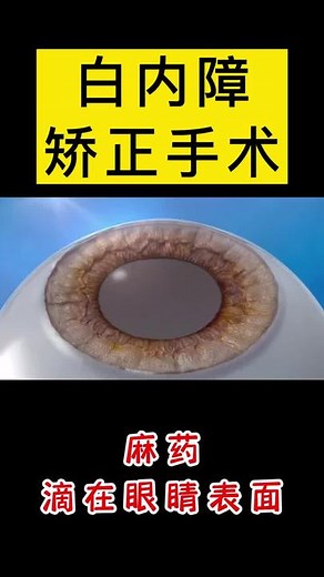 白内障手術の全貌と注意点