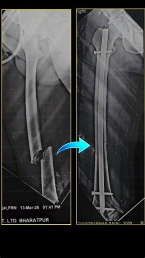 Next Day of Femur bone fracture Surgery of Mr. Chandrabhan #fracturetreatment