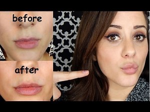 My Juvederm Lip Injection Experience