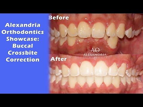 Alexandria Orthodontics Showcase: Buccal crossbite