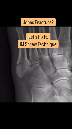 Naji S. Madi, MD on Instagram: "📌 👣 Jones Fracture Fix – IM Screw Technique (X-ray only!) Watch step-by-step how to manage a true Jones fracture (Zone 2) using intramedullary screw fixation. Precise technique, all visualized through X-rays. 🛠️ Covered in here: ✔️ Identifying the fracture ✔️ Finding the correct entry point ✔️ Finding the correct screw diameter ✔️ Guidepin and screw placement ✔️ Final X-ray confirmation ✔️ Post-op protocol 💡 Did you know? Plate fixation is another valid approa