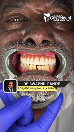Upper Full Mouth Dental Implant in 72 Hours Mira Road Mumbai Before & After
