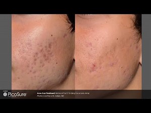 Laser Acne Scar Removal - Pulse light Clinic London