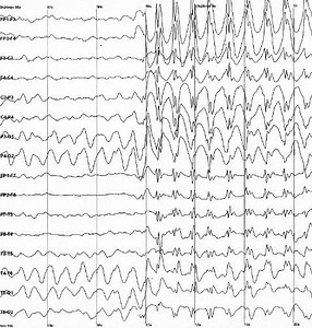 Epileptic seizure - Alchetron, The Free Social Encyclopedia
