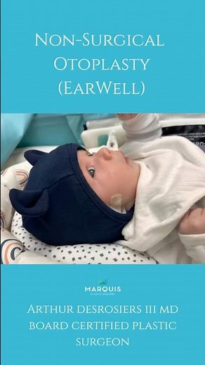 Baby ear deformity treated with non-surgical ear molding (EarWell procedure) #plasticsurgeon #miami
