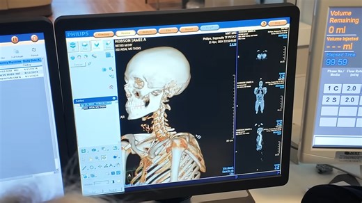 What 1,000 microns of nanotech did to my skeleton - 16x stronger