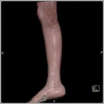 Vascular:CTA leg:Specific CT angiographic displays targeting the trifurcation vessels(4 of 8)