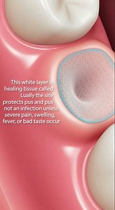 🦷 White Stuff After a Tooth Extraction? Here’s What It Usually Means