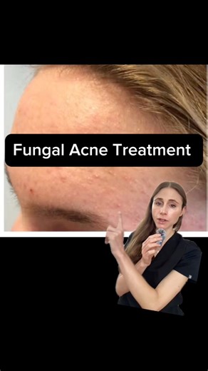 15K views · 83 reactions | “Fungal Acne” Treatment That Actually Works. #fungalacne #skincaretips #dermatologist | Dr Dray | Facebook