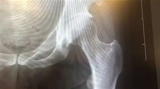 Pediatric hip dysplasia screening and early intervention