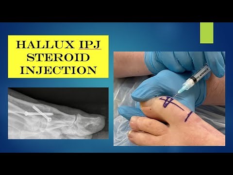 Injection - hallux IP jt. steroid injection
