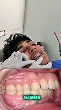 "TRANSFORMA TU MANDÍBULA CON ORTODONCIA: 💪✨ LOGRA UN AVANCE MANDIBULAR Y UN PERFIL MÁS MARCADO"