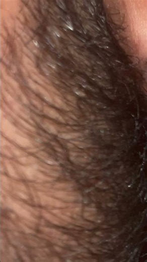 #blackheadcaique #pimple #oddlysatisfying #thebarbersarms #beard #blackheads