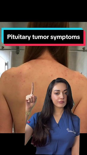 A pituitary tumor is an abnormal growth in the pituitary gland. Most pituitary tumors are not cancer (benign). The pituitary is a small gland located at the base of the brain. It makes hormones that affect many other glands and many functions in your body. Pituitary tumors can cause various skin symptoms like thickened skin, hyperpigmentation, acne, hirsutism, and dry skin, due to hormonal imbalances from conditions like acromegaly, Cushing’s disease, and hyperprolactinemia. #pituitarytumor #pit