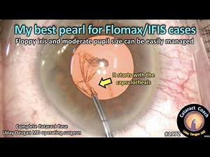 CataractCoach 1372: my best pearl for IFIS / floppy iris / Flomax cataract surgery
