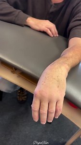 14K views · 55 reactions | Wrist drop is a clinical sign of radial nerve palsy, typically resulting from nerve compression or trauma. It presents as an inability to actively extend the wrist and fingers, leading to a characteristic “dropped” hand posture. Common causes include prolonged pressure on the upper arm, humeral fractures, or surgical complications. Early diagnosis and targeted therapy are key to recovery. | PhysioFixers | Facebook