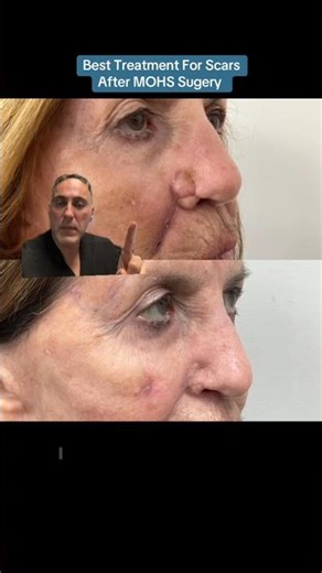Best Treatment for Scars after Mohs Surgery