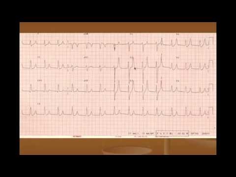 Hyperkalemia: Treatment and ECG Changes